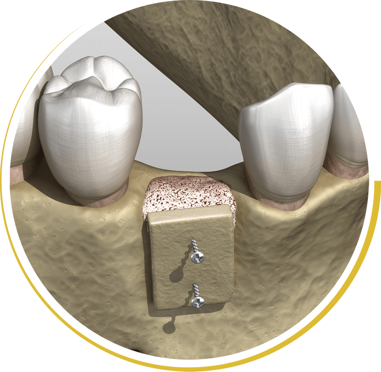 bone graft graphic