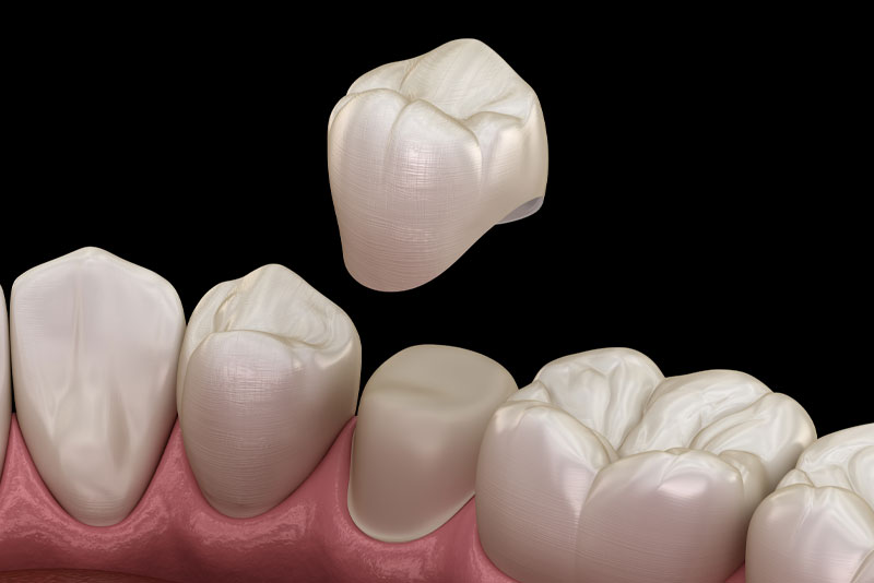 dental crowns model