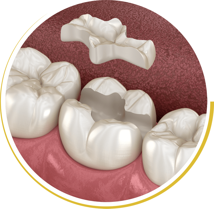 dental filling model