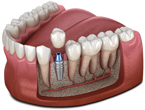 dental implant model