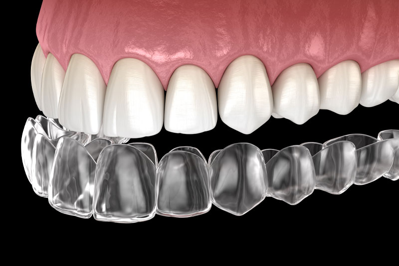 invisalign graphic