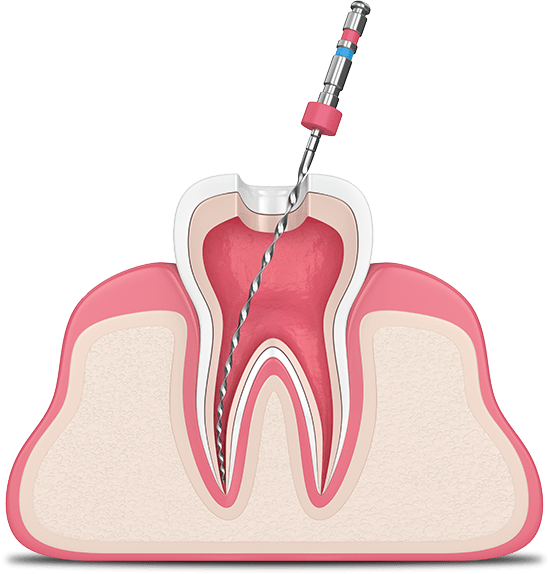 root canal graphic