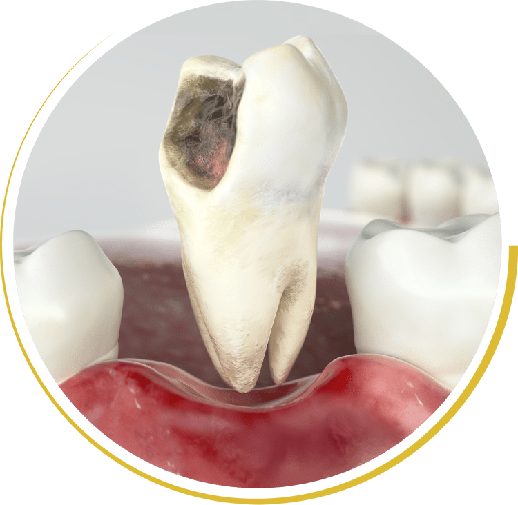 tooth extraction graphic